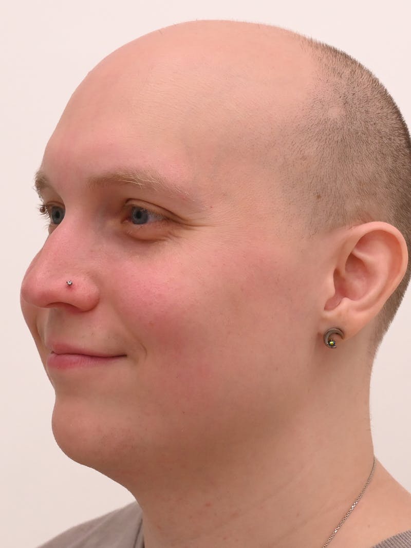 Rhinoplasty Before & After Gallery - Patient 521920 - Image 5