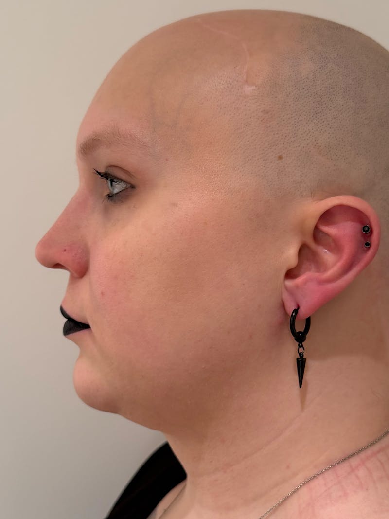 Rhinoplasty Before & After Gallery - Patient 521920 - Image 10