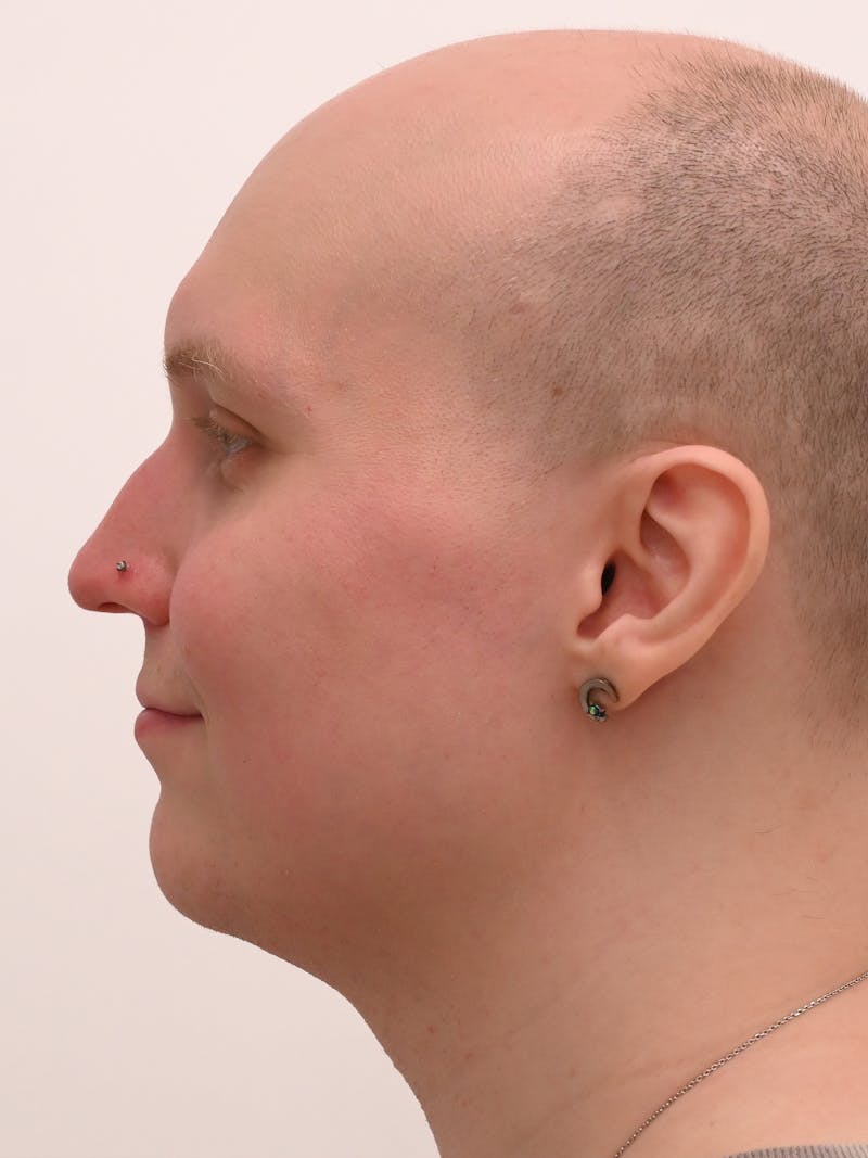 Rhinoplasty Before & After Gallery - Patient 521920 - Image 9