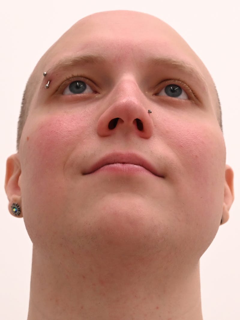 Rhinoplasty Before & After Gallery - Patient 521920 - Image 11