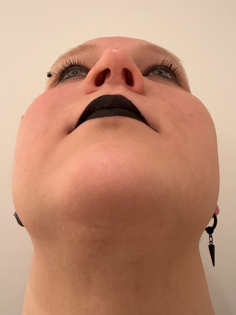 Rhinoplasty Before & After Gallery - Patient 521920 - Image 12