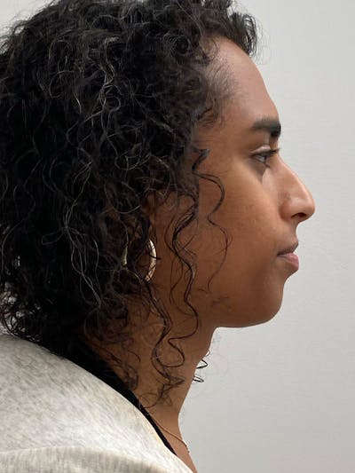 Rhinoplasty Before & After Gallery - Patient 324816 - Image 1