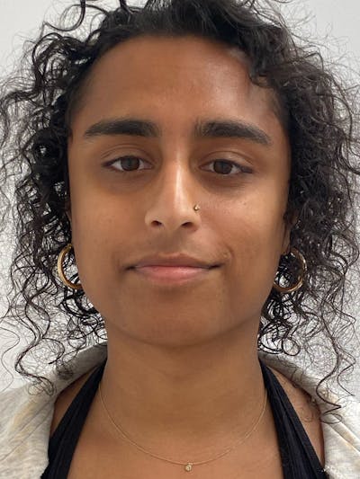 Mandible Angles Before & After Gallery - Patient 327138 - Image 1