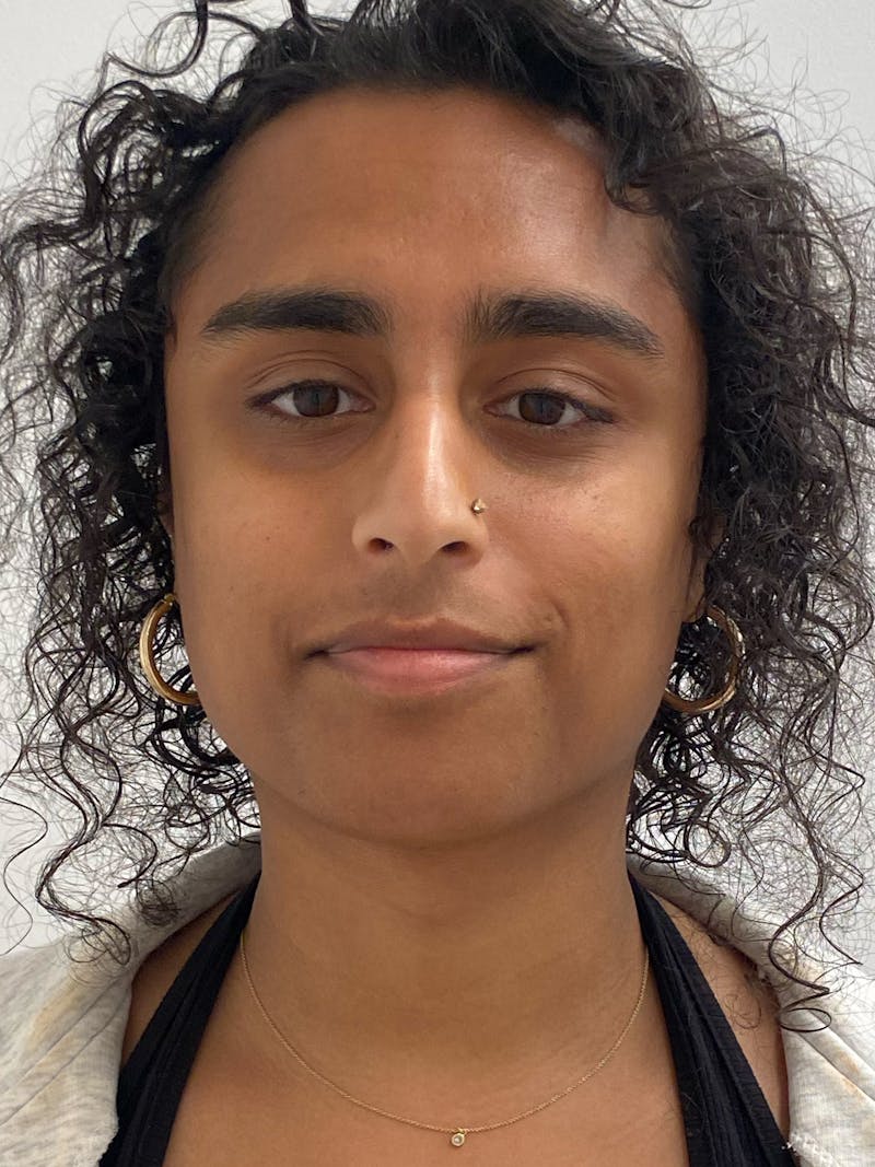 Rhinoplasty Before & After Gallery - Patient 324816 - Image 3