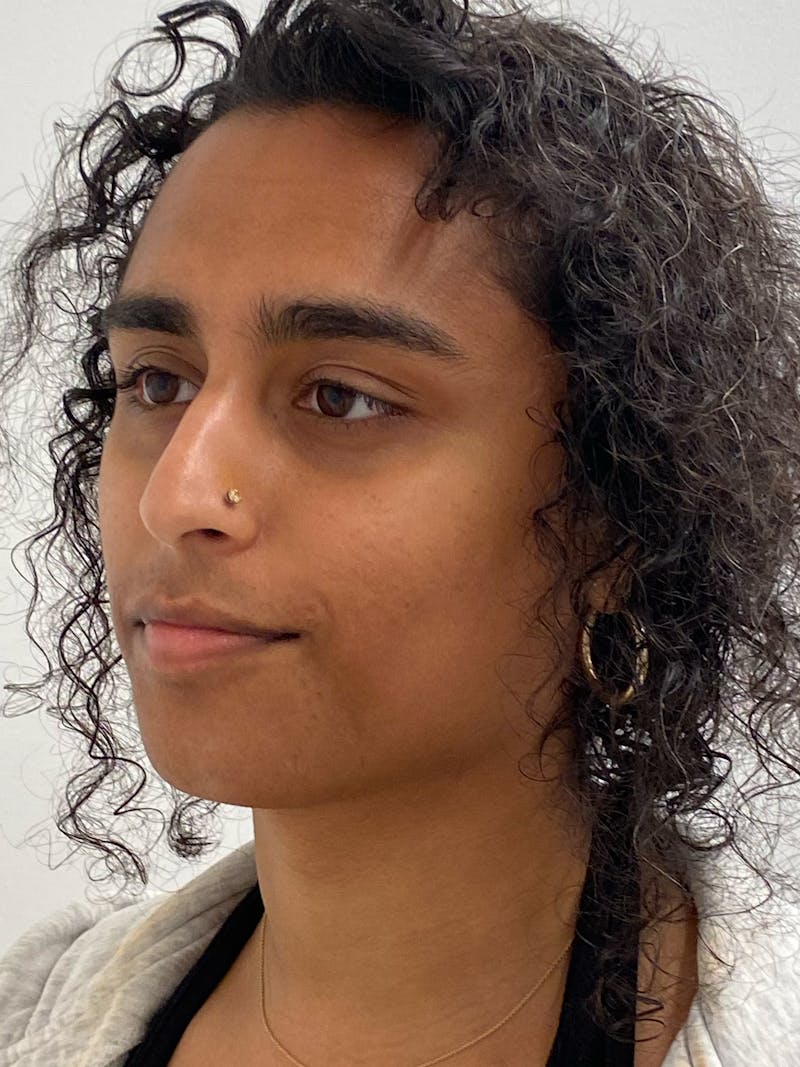 Rhinoplasty Before & After Gallery - Patient 324816 - Image 5