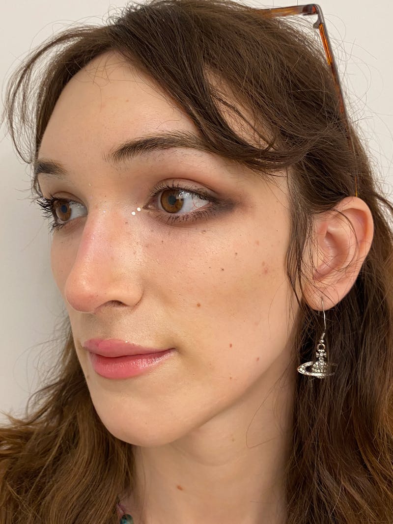 Rhinoplasty Before & After Gallery - Patient 375662 - Image 6