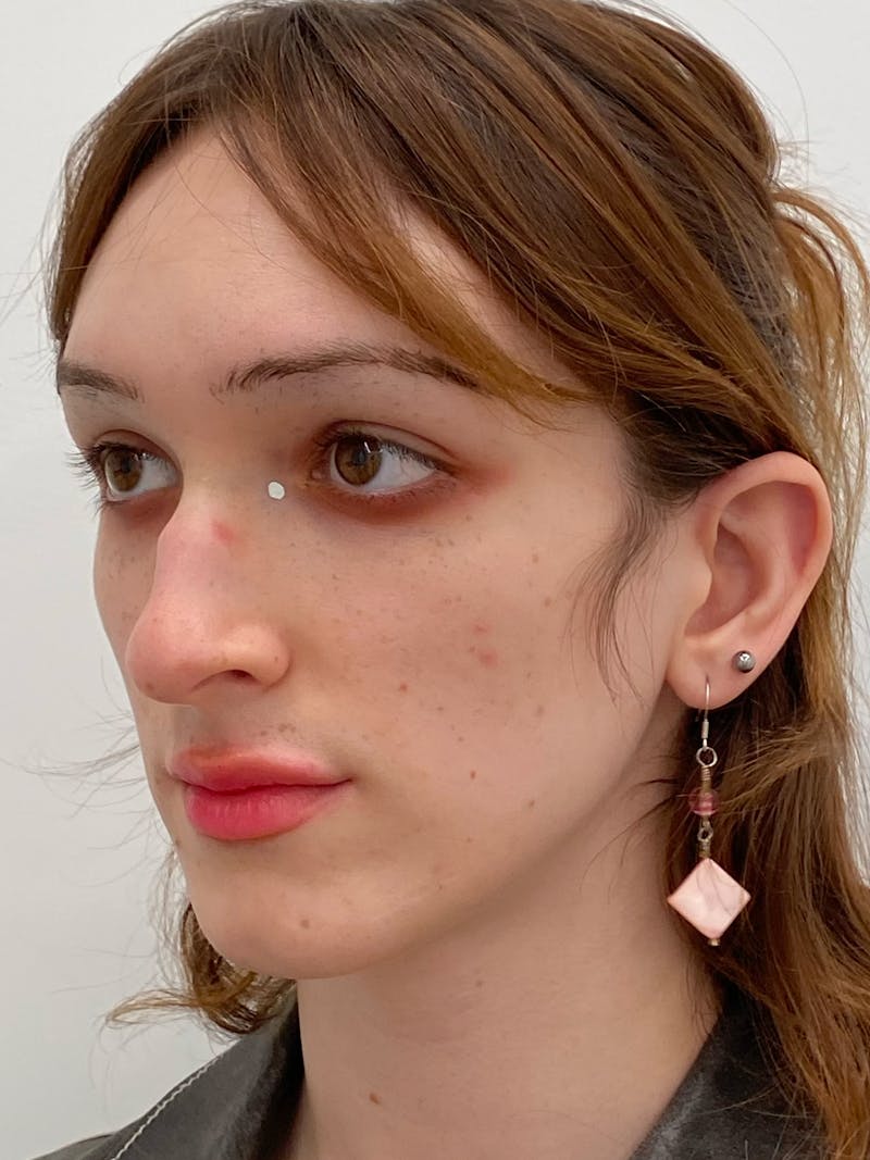 Rhinoplasty Before & After Gallery - Patient 375662 - Image 5