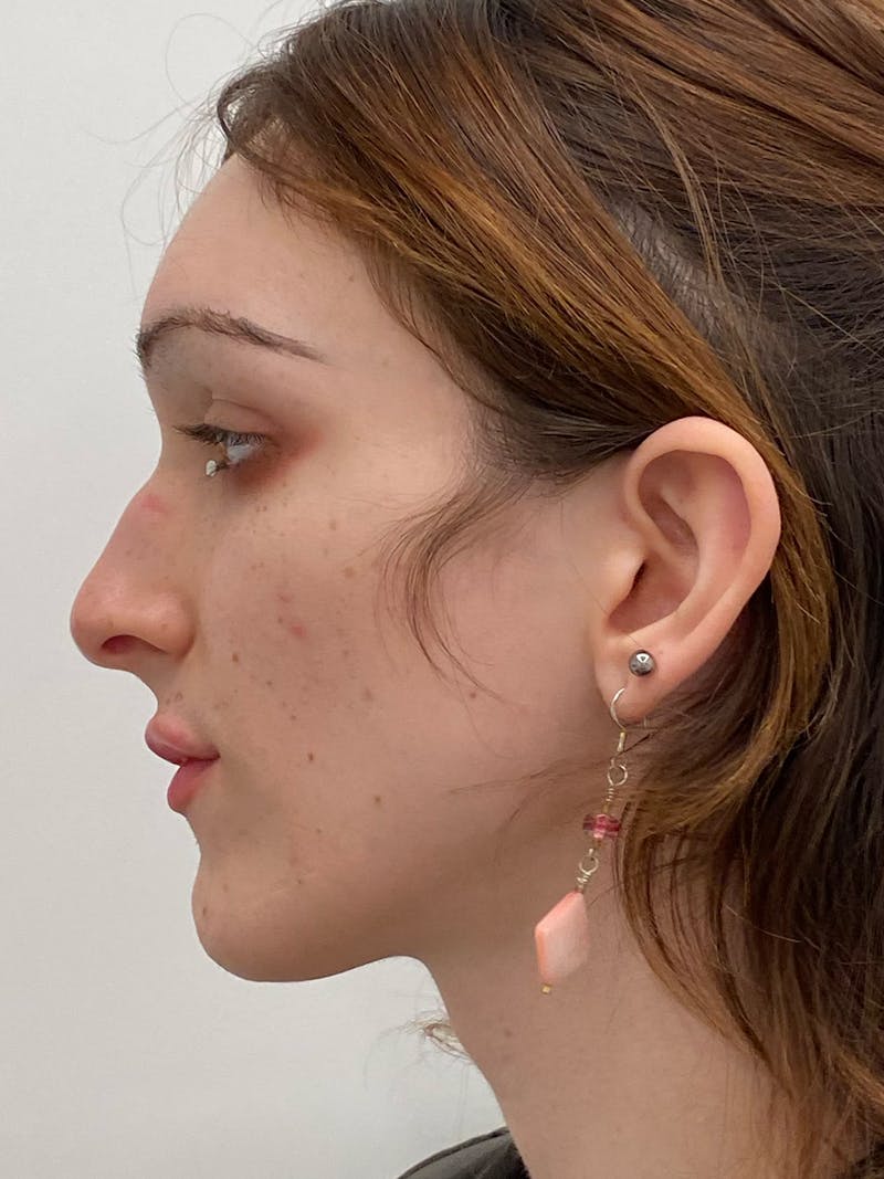 Rhinoplasty Before & After Gallery - Patient 375662 - Image 7