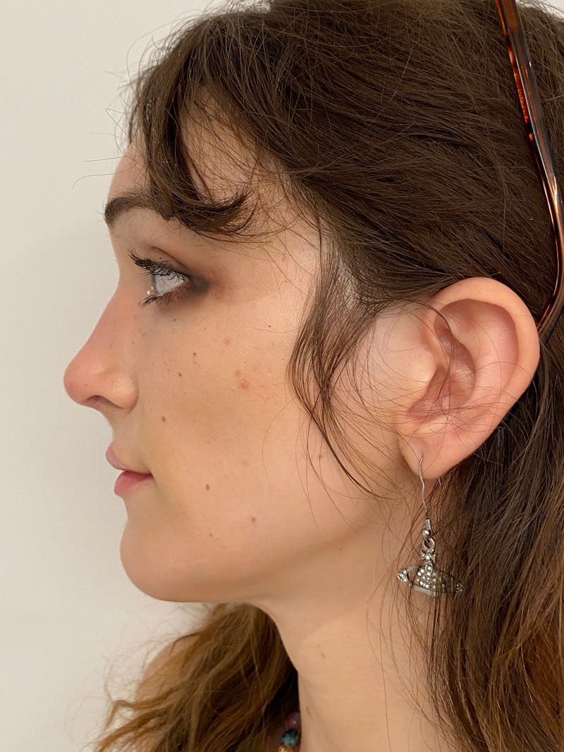 Rhinoplasty Before & After Gallery - Patient 375662 - Image 8