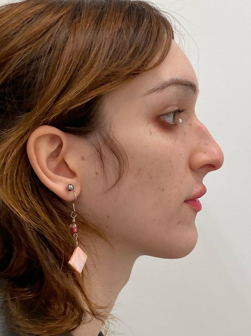 Rhinoplasty Before & After Gallery - Patient 375662 - Image 1