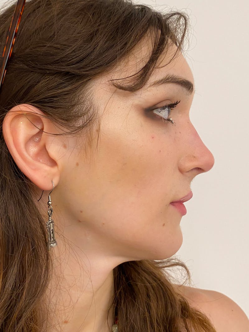 Rhinoplasty Before & After Gallery - Patient 375662 - Image 2