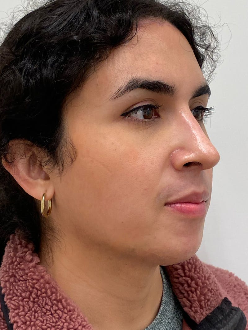 Rhinoplasty Before & After Gallery - Patient 279742 - Image 6