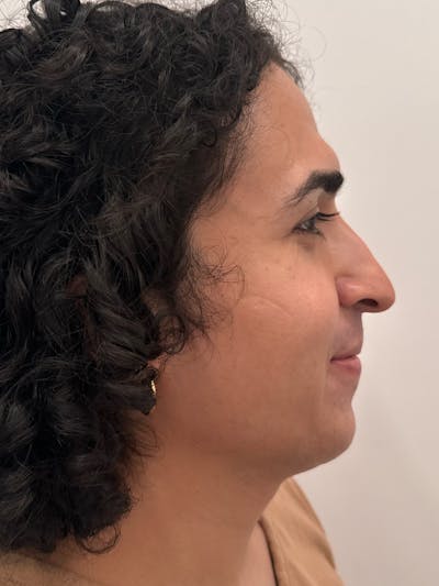 Rhinoplasty Before & After Gallery - Patient 279742 - Image 1