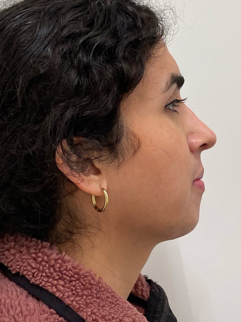 Rhinoplasty Before & After Gallery - Patient 279742 - Image 2