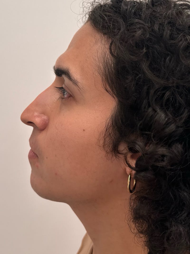 Rhinoplasty Before & After Gallery - Patient 279742 - Image 7