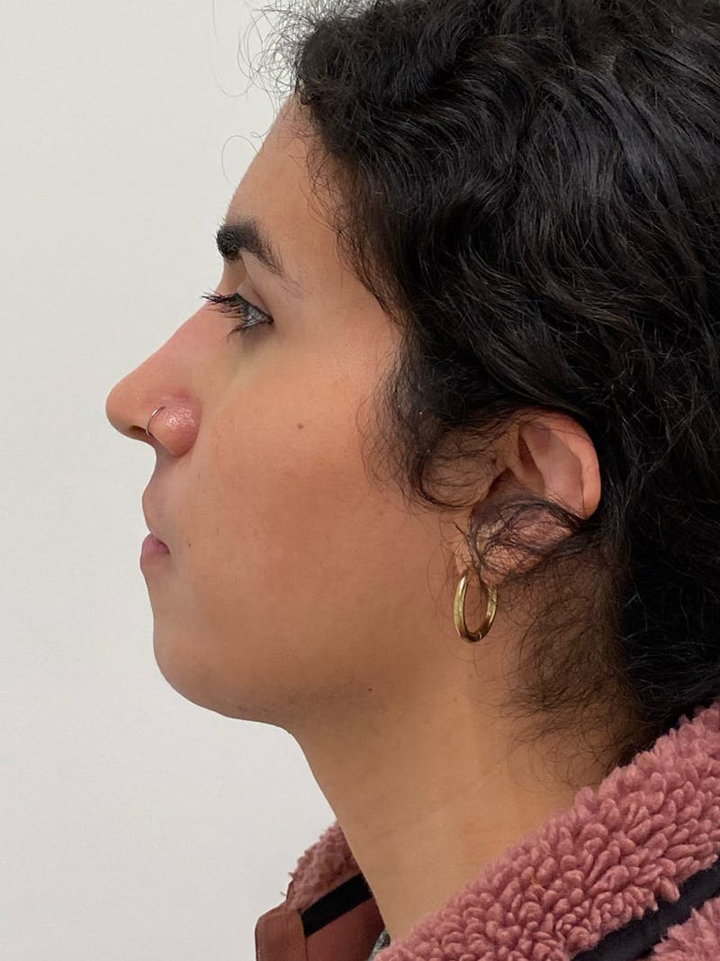 Rhinoplasty Before & After Gallery - Patient 279742 - Image 8