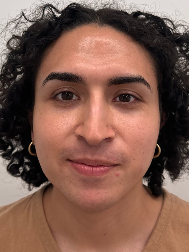 Rhinoplasty Before & After Gallery - Patient 279742 - Image 3