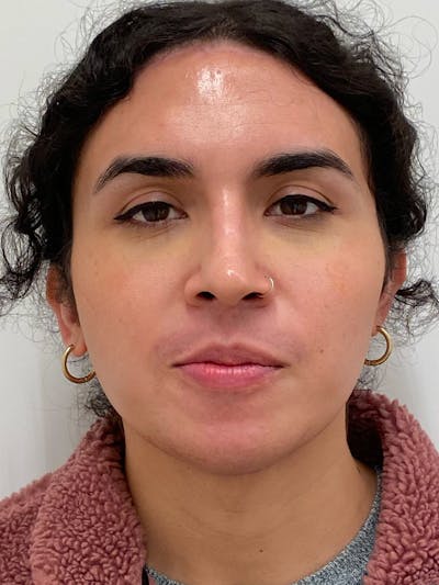 Forehead Reduction Before & After Gallery - Patient 397094 - Image 2