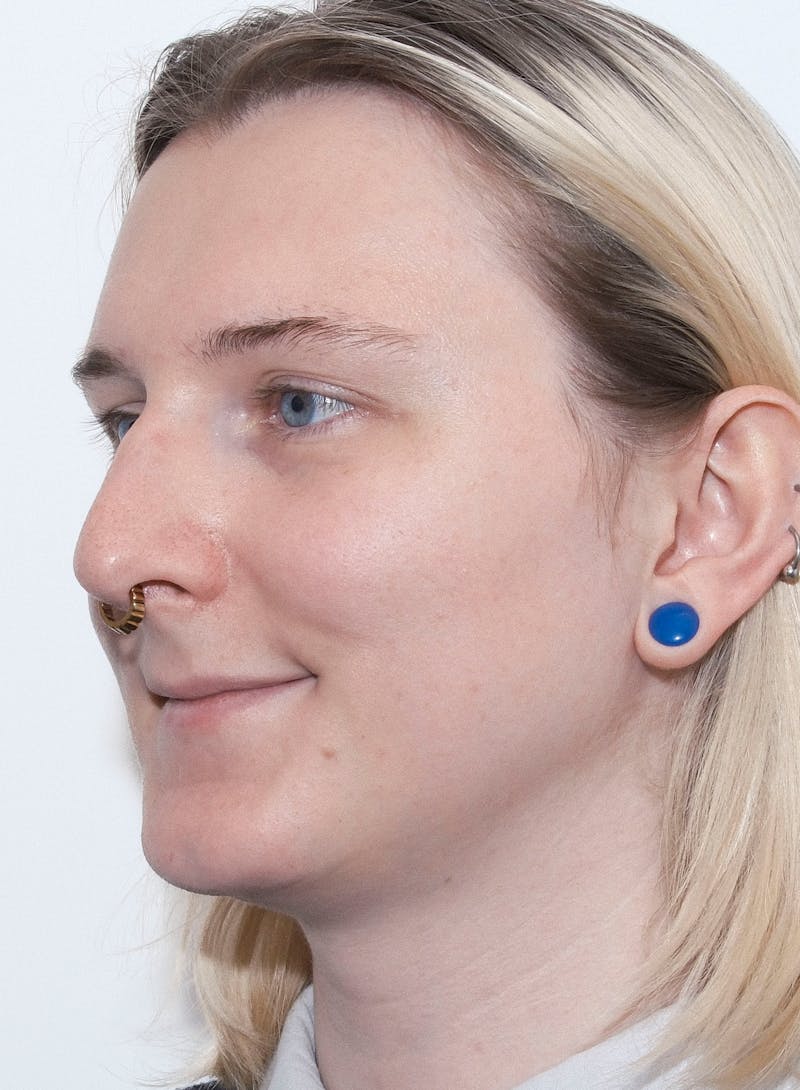 Rhinoplasty Before & After Gallery - Patient 306837 - Image 5