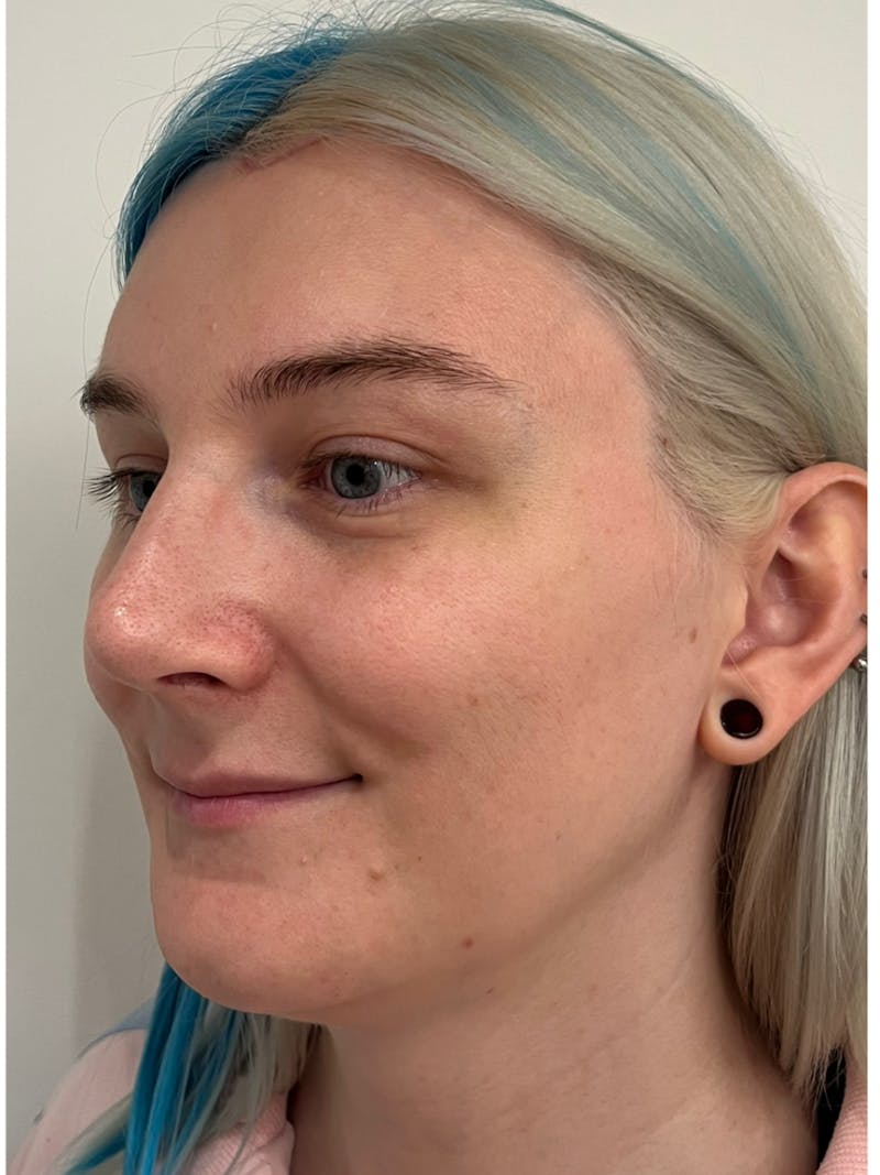 Rhinoplasty Before & After Gallery - Patient 306837 - Image 6