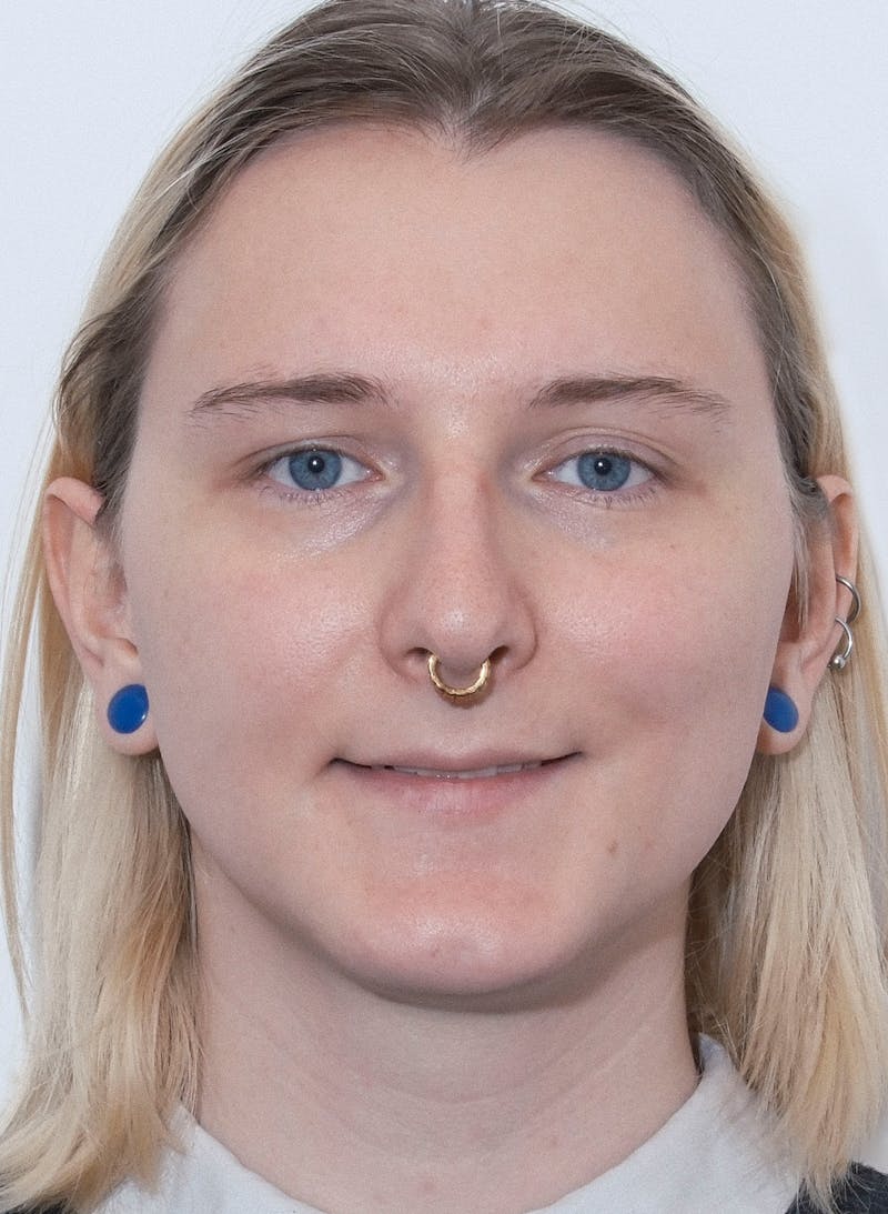 Rhinoplasty Before & After Gallery - Patient 306837 - Image 3