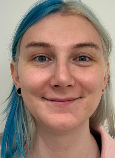 Genioplasty Before & After Gallery - Patient 164622 - Image 2