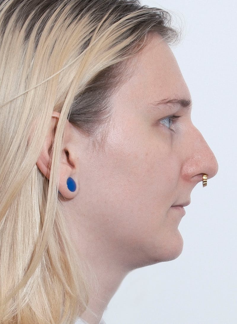 Rhinoplasty Before & After Gallery - Patient 306837 - Image 1