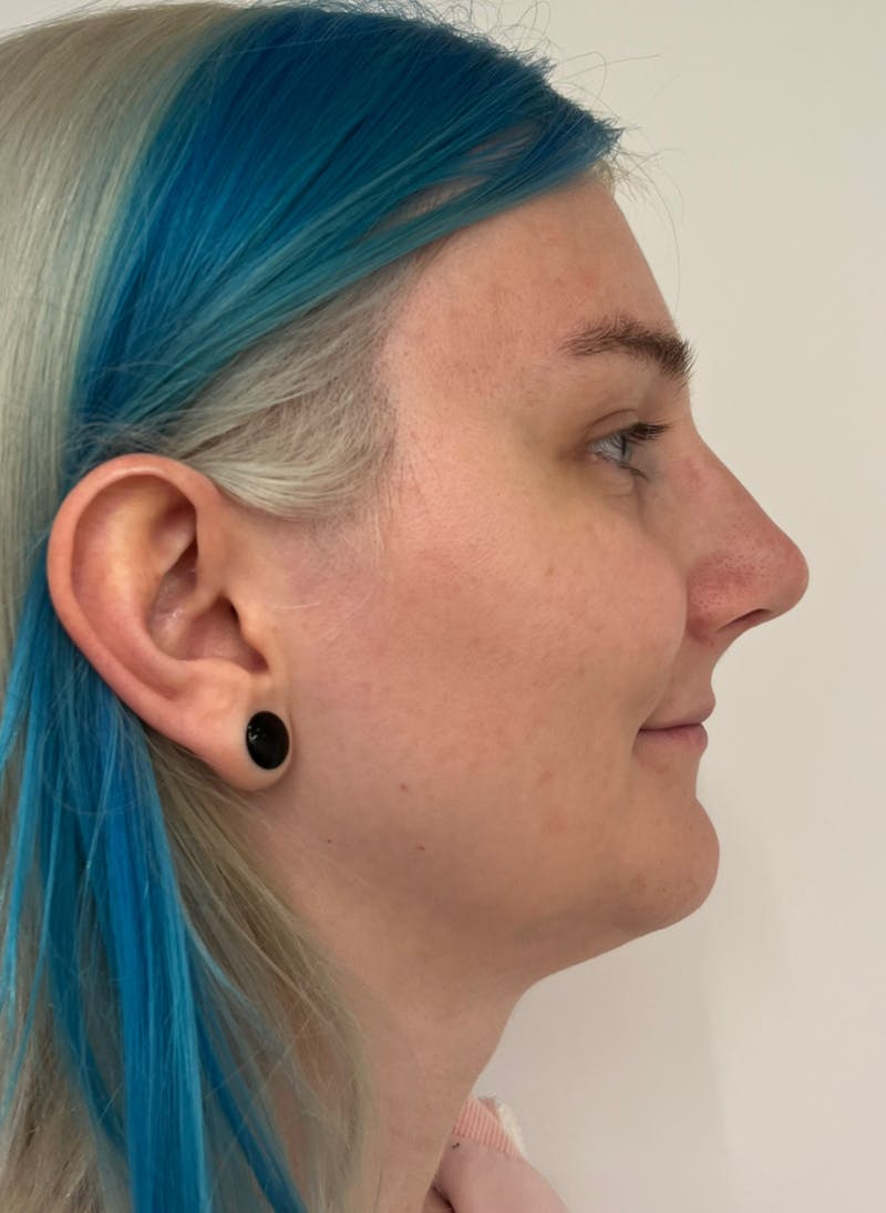 Rhinoplasty Before & After Gallery - Patient 306837 - Image 2