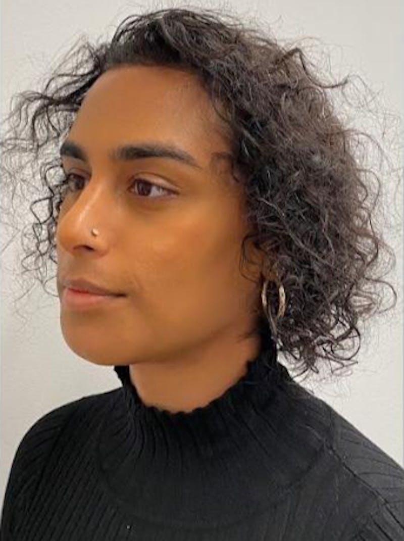 Rhinoplasty Before & After Gallery - Patient 324816 - Image 6