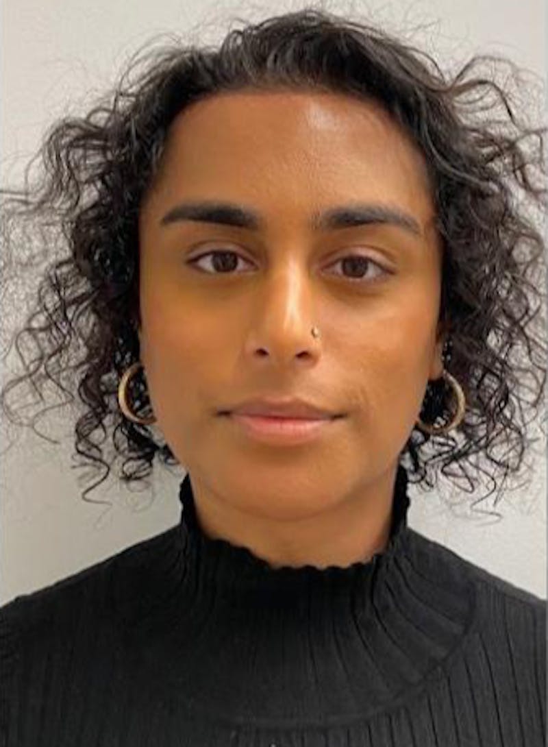 Rhinoplasty Before & After Gallery - Patient 324816 - Image 4