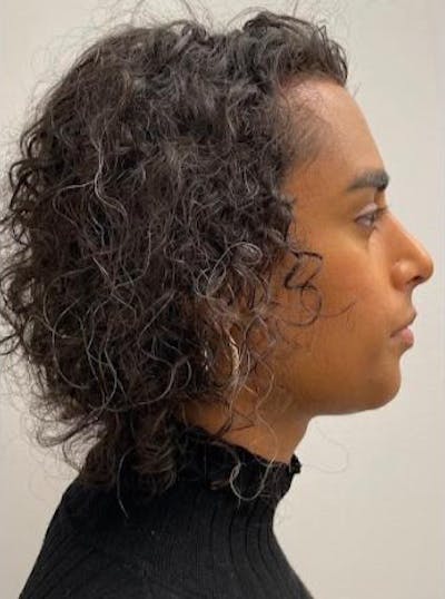Rhinoplasty Before & After Gallery - Patient 324816 - Image 2