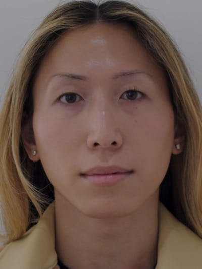 Genioplasty Before & After Gallery - Patient 191791 - Image 1