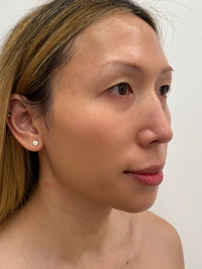 Lip Augmentation Before & After Gallery - Patient 313591 - Image 4