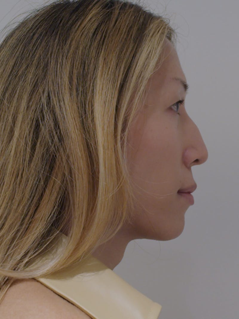 Lip Augmentation Before & After Gallery - Patient 313591 - Image 5