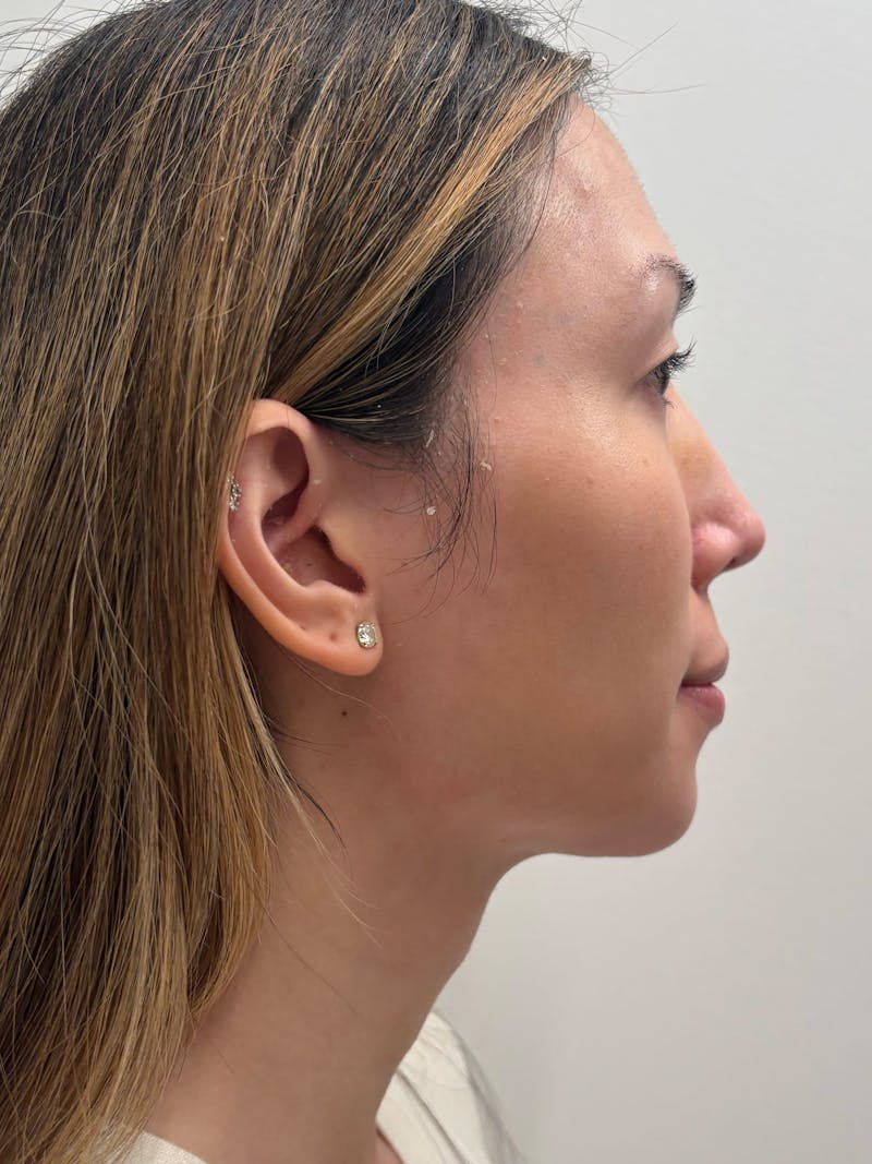 Lip Augmentation Before & After Gallery - Patient 313591 - Image 6