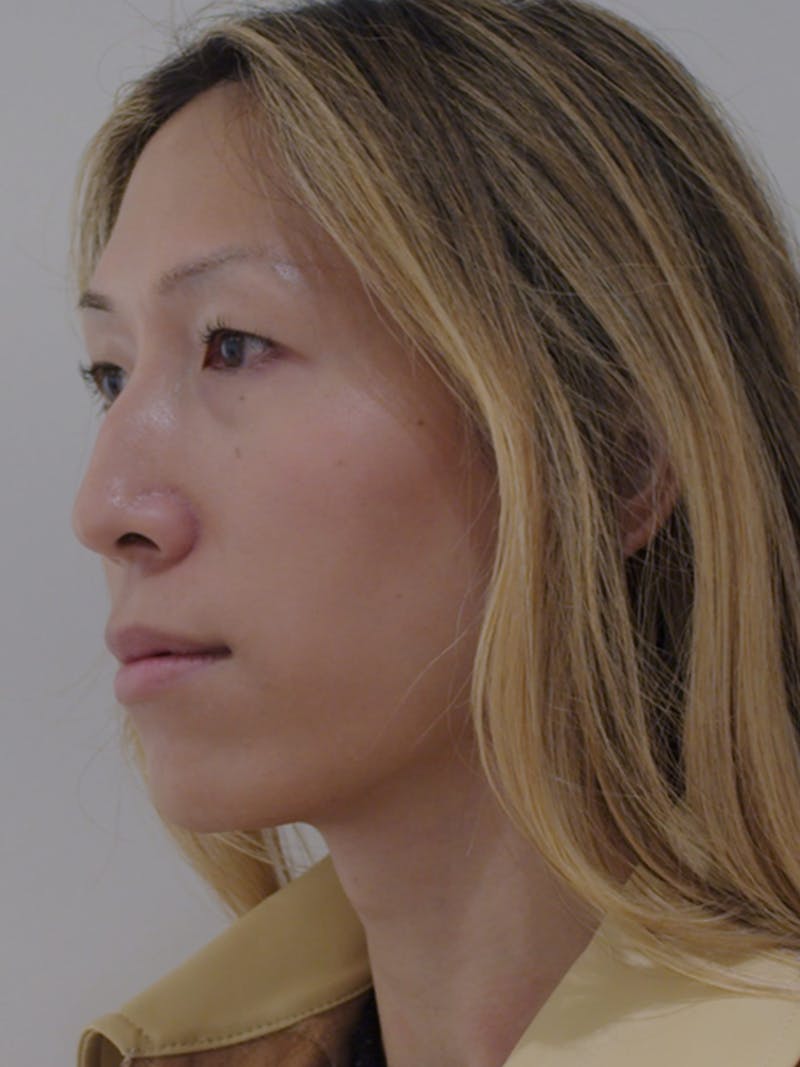 Lip Augmentation Before & After Gallery - Patient 313591 - Image 7