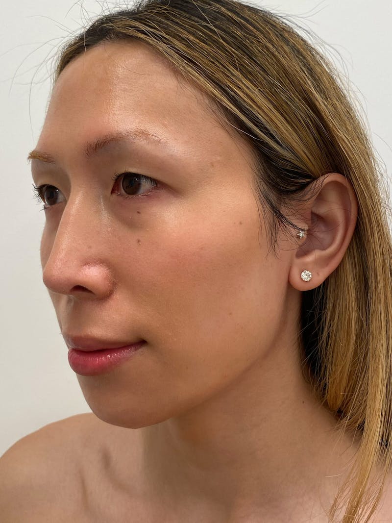 Lip Augmentation Before & After Gallery - Patient 313591 - Image 8