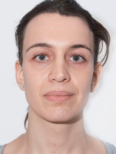 Genioplasty Before & After Gallery - Patient 212730 - Image 1