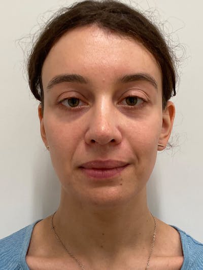 Genioplasty Before & After Gallery - Patient 212730 - Image 2