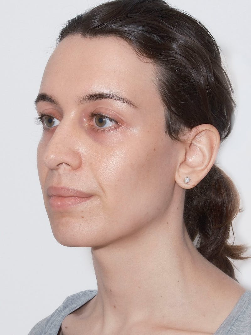 Cheek Augmentation Before & After Gallery - Patient 169460 - Image 1