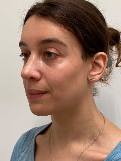 Cheek Augmentation Before & After Gallery - Patient 169460 - Image 2
