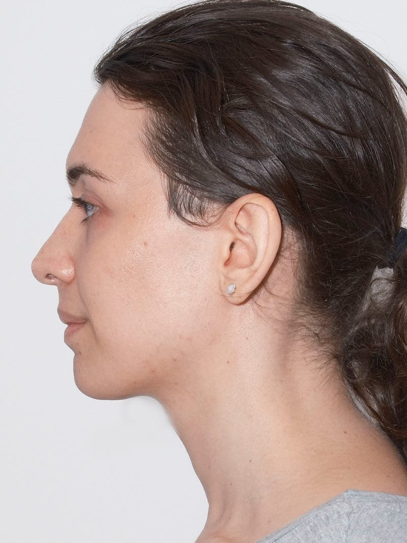 Cheek Augmentation Before & After Gallery - Patient 169460 - Image 5