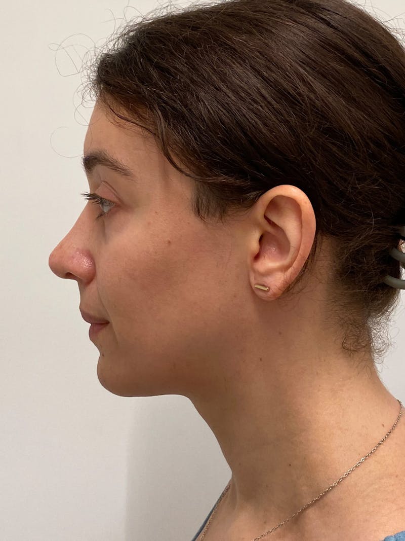 Cheek Augmentation Before & After Gallery - Patient 169460 - Image 6