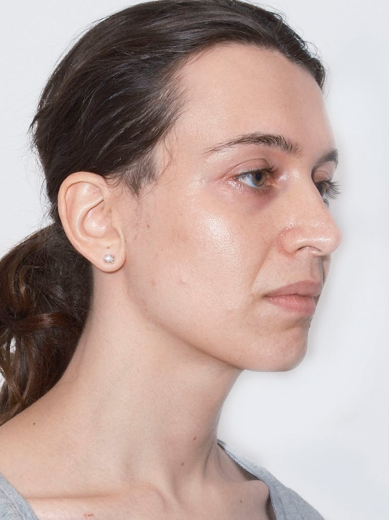 Cheek Augmentation Before & After Gallery - Patient 169460 - Image 7