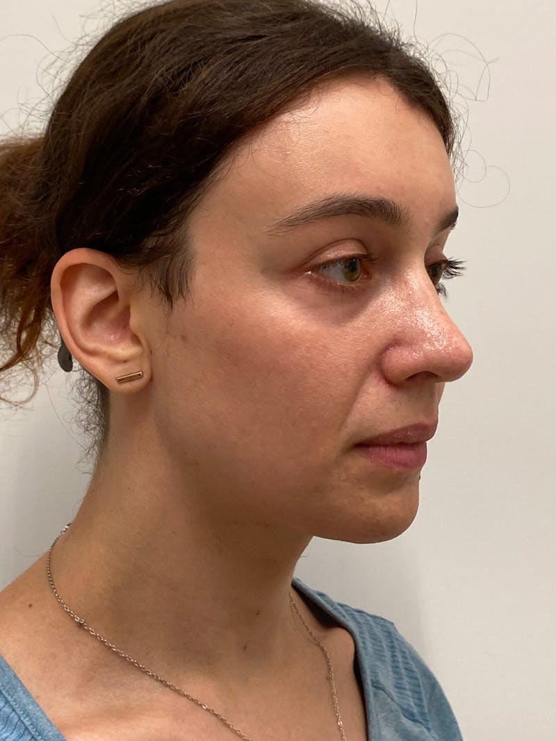 Cheek Augmentation Before & After Gallery - Patient 169460 - Image 8