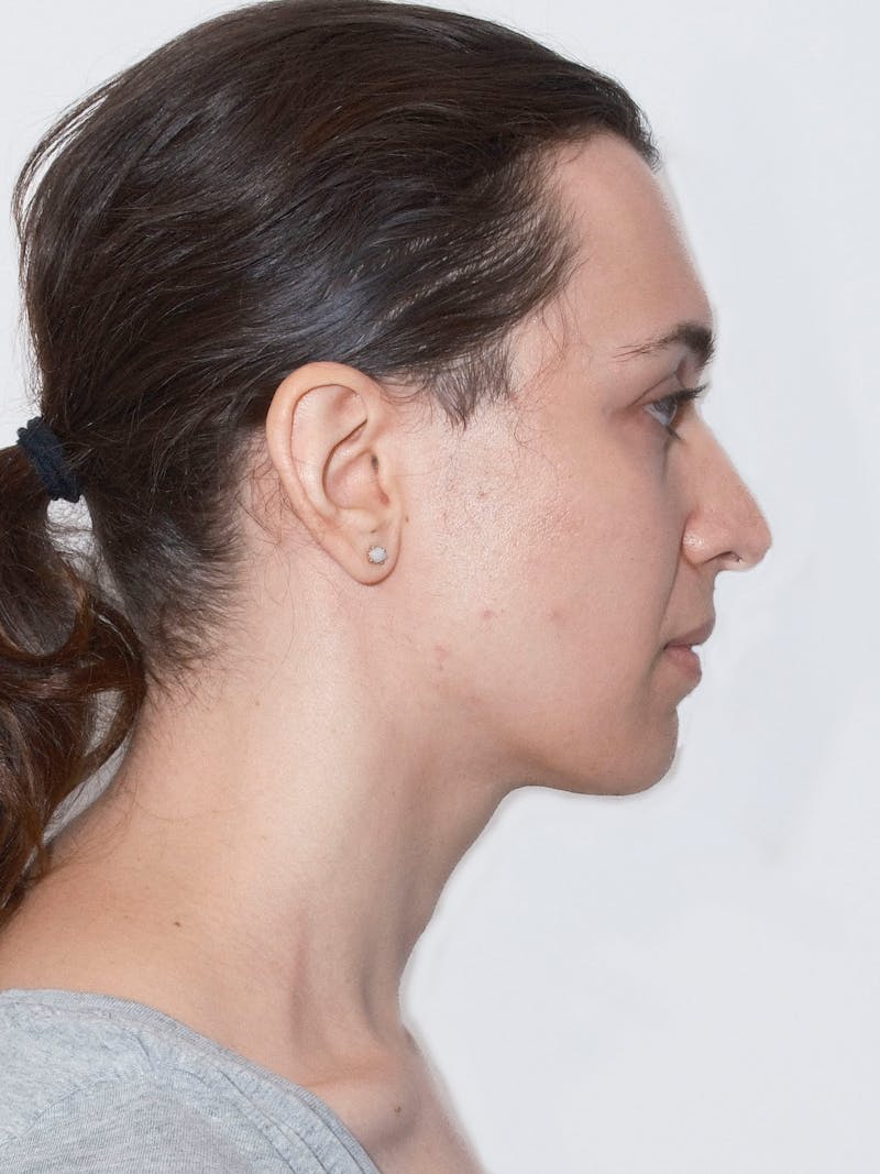 Cheek Augmentation Before & After Gallery - Patient 169460 - Image 9