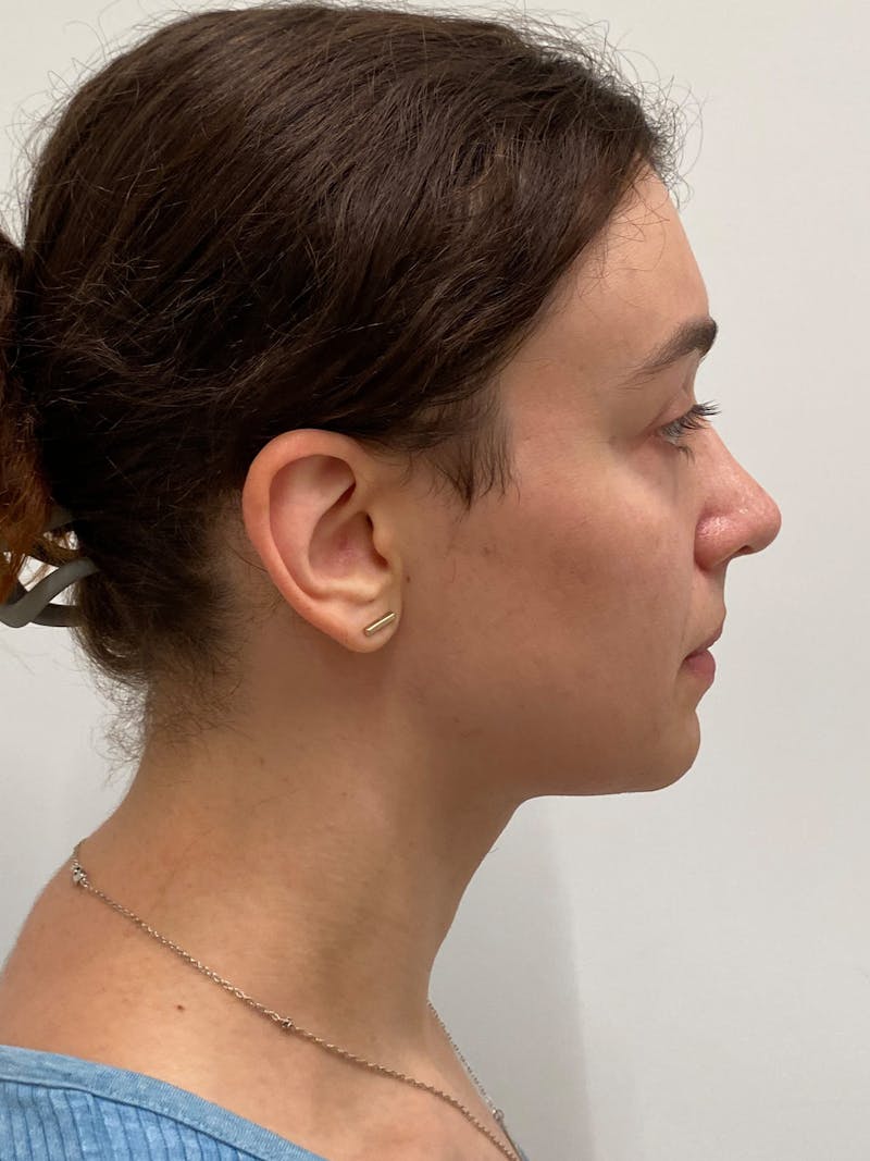 Cheek Augmentation Before & After Gallery - Patient 169460 - Image 10
