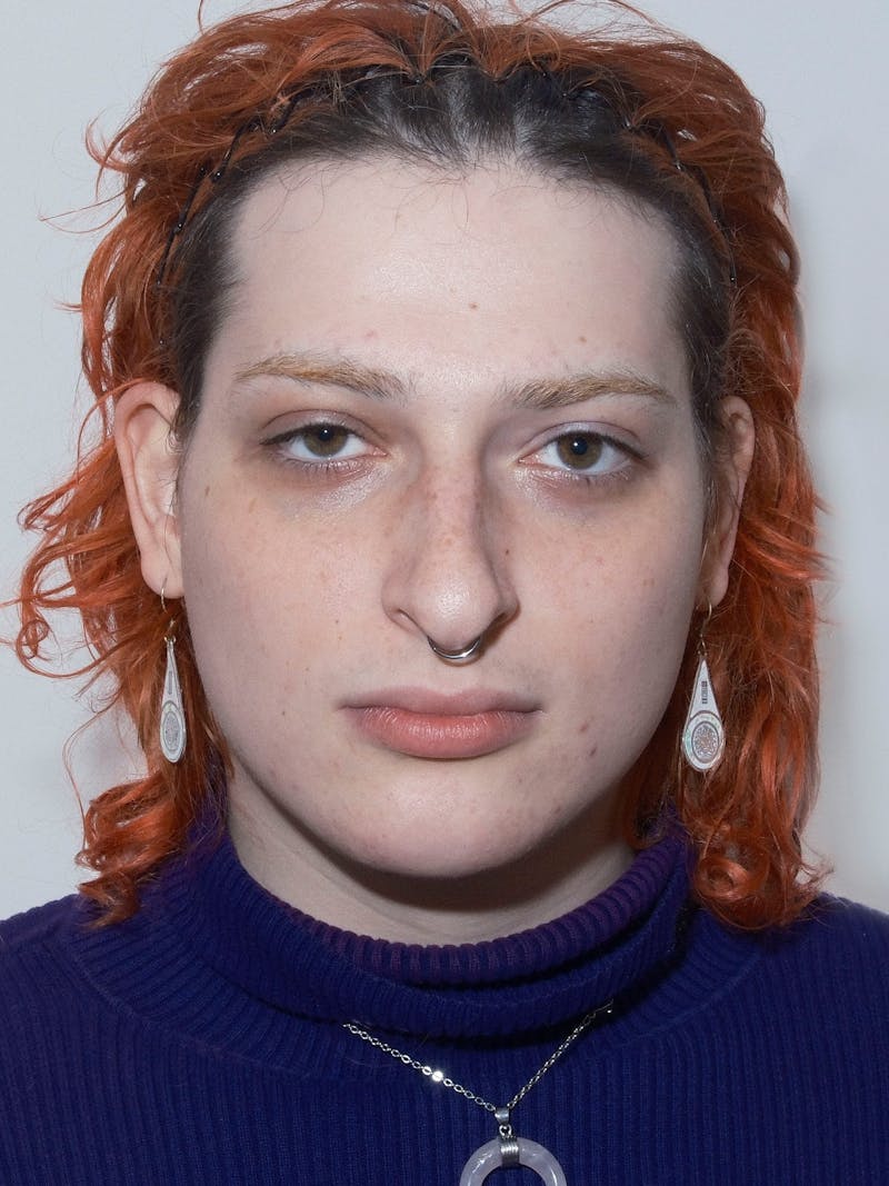 Genioplasty Before & After Gallery - Patient 126208 - Image 1