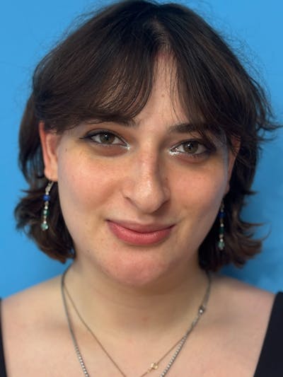 Genioplasty Before & After Gallery - Patient 126208 - Image 2