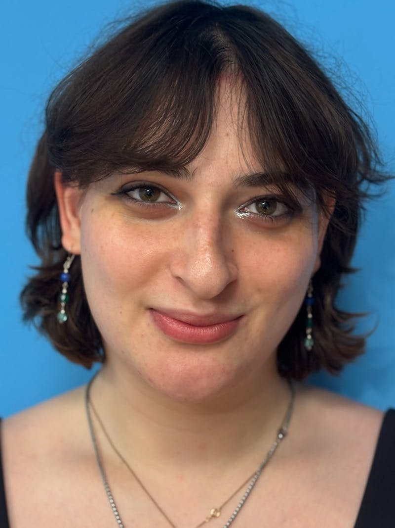 Genioplasty Before & After Gallery - Patient 126208 - Image 2